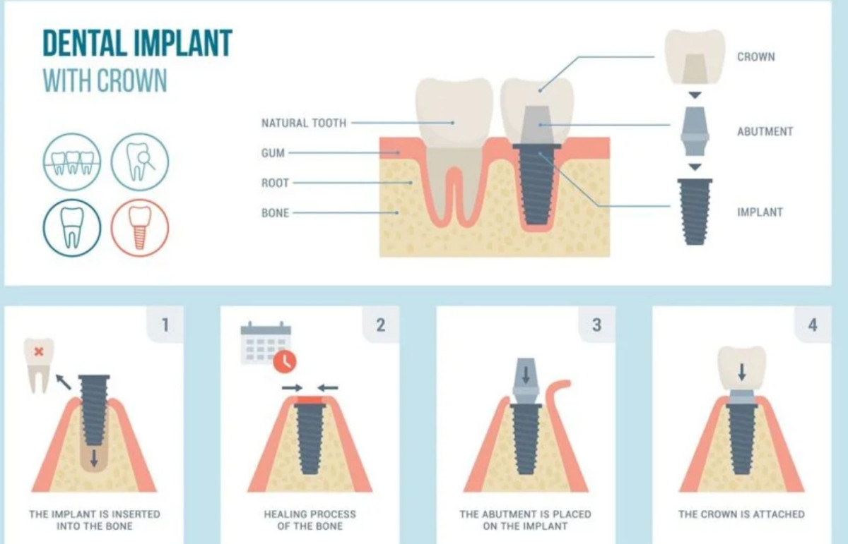 How to Get Affordable Dental Implants Without Sacrificing Quality